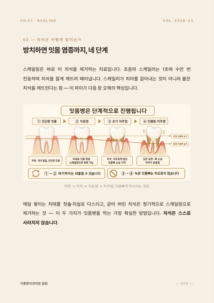 6면 잇몸병 4단계 진행